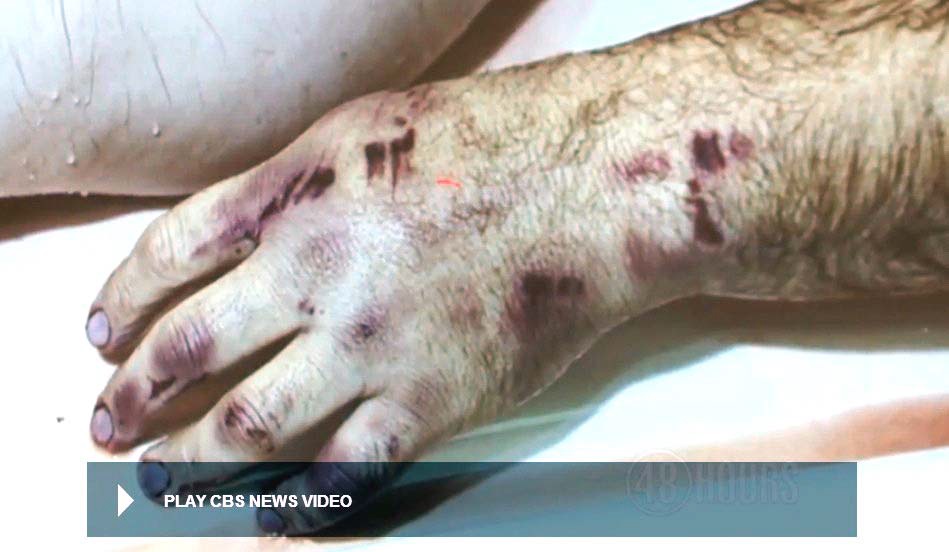 Autopsy photo of victim’s left hand after removal of the excess blood. Six or more separate impact blows from the weapon can be discerned. Modified still from CBS news video.