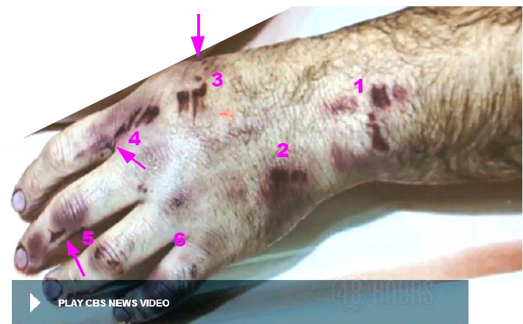 View of victim’s left hand showing at least six impacts from the assault weapon with differing injuries. The abrasive markings at site 2 and at the ring finger have a dual contact appearance. Modified still from CBS News Video.