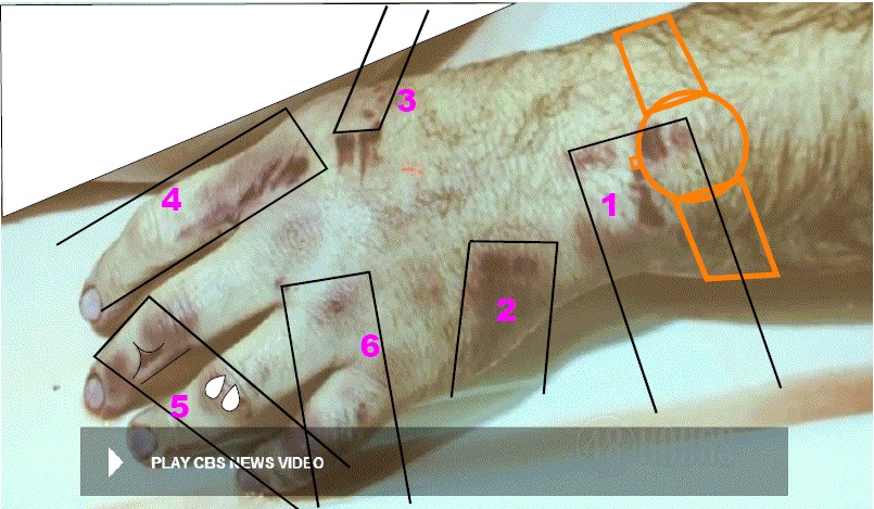 Photo of victim’s right hand with the same numbering for the six injury locales as depicted in the article seven on the victim’s injuries. One added feature is an orange outline of a wrist watch to correspond with the Timex watch believed to have been worn by the victim at the time of the attack. Also added are rectangular outlines to reflect how a rectangular object with certain protruding and sharp edge features along its thickness could have induced injuries 2 through 6. Injury 1 could have been mostly induced from an impact to the watch which caused the watch stem and band connector features to dig into the skin and induce most of the injuries at this location. The rectangular outline could have been drawn the same width in all but they were drawn at varying widths since the actual weapon width is unknown. Modified CBS News photo.